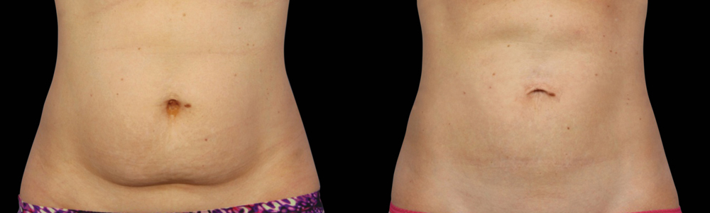 CoolSculpting before and after photo by Columbus Institute of Plastic Surgery in Columbus, OH