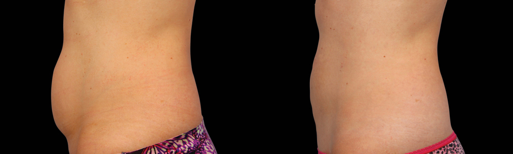 CoolSculpting before and after photo by Columbus Institute of Plastic Surgery in Columbus, OH