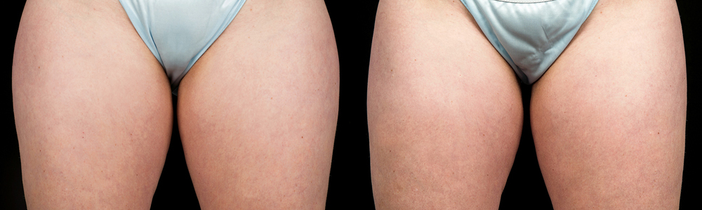 CoolSculpting before and after photo by Columbus Institute of Plastic Surgery in Columbus, OH