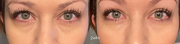 Fillers and Botox before and after photo by Columbus Institute of Plastic Surgery in Columbus, OH