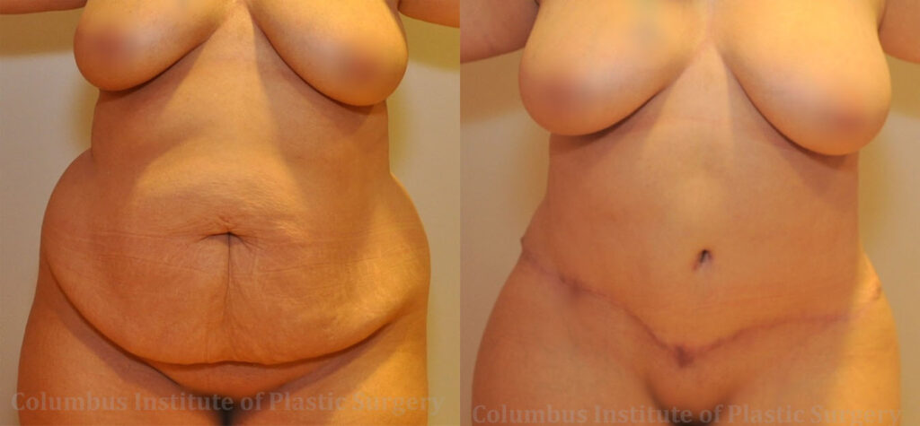 Abdominoplasty (Tummy Tuck) before and after photo by Columbus Institute of Plastic Surgery in Columbus, OH