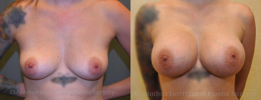 Breast Augmentation – 400cc-500cc before and after photo by Columbus Institute of Plastic Surgery in Columbus, OH
