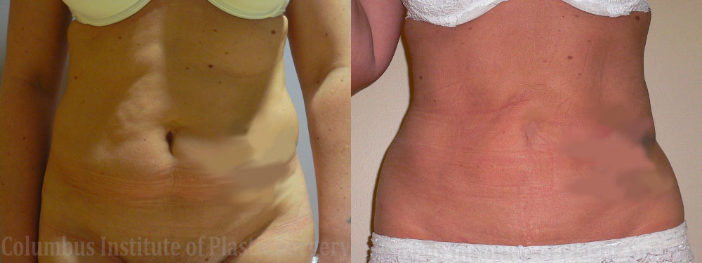Liposuction before and after photo by Columbus Institute of Plastic Surgery in Columbus, OH