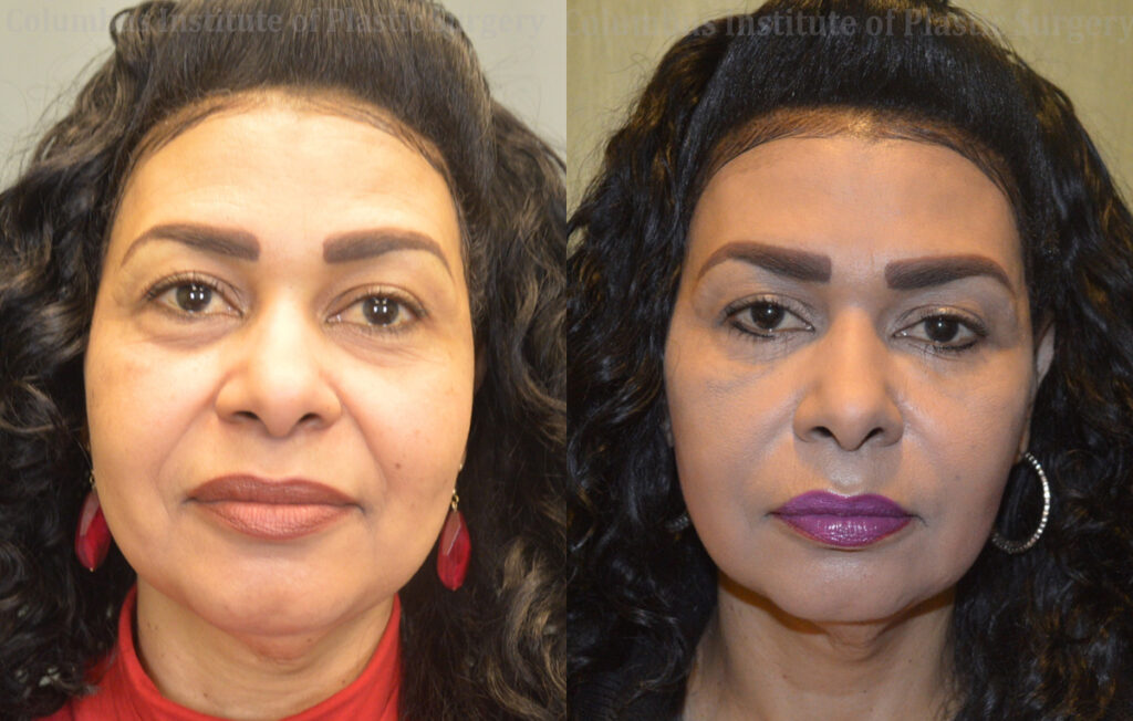 Fillers and Botox before and after photo by Columbus Institute of Plastic Surgery in Columbus, OH