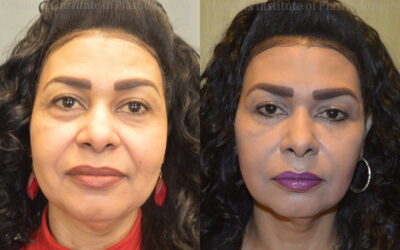 Fillers and Botox before and after photo by Columbus Institute of Plastic Surgery in Columbus, OH Fillers and Botox before and after photo by Columbus Institute of Plastic Surgery in Columbus, OH