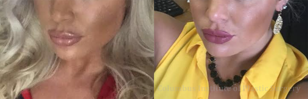 Fillers and Botox before and after photo by Columbus Institute of Plastic Surgery in Columbus, OH
