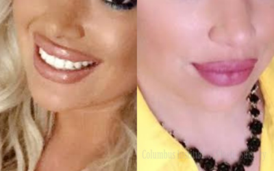 Fillers and Botox before and after photo by Columbus Institute of Plastic Surgery in Columbus, OH Fillers and Botox before and after photo by Columbus Institute of Plastic Surgery in Columbus, OH