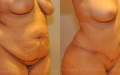 Abdominoplasty (Tummy Tuck) before and after photo by Columbus Institute of Plastic Surgery in Columbus, OH Abdominoplasty (Tummy Tuck) before and after photo by Columbus Institute of Plastic Surgery in Columbus, OH