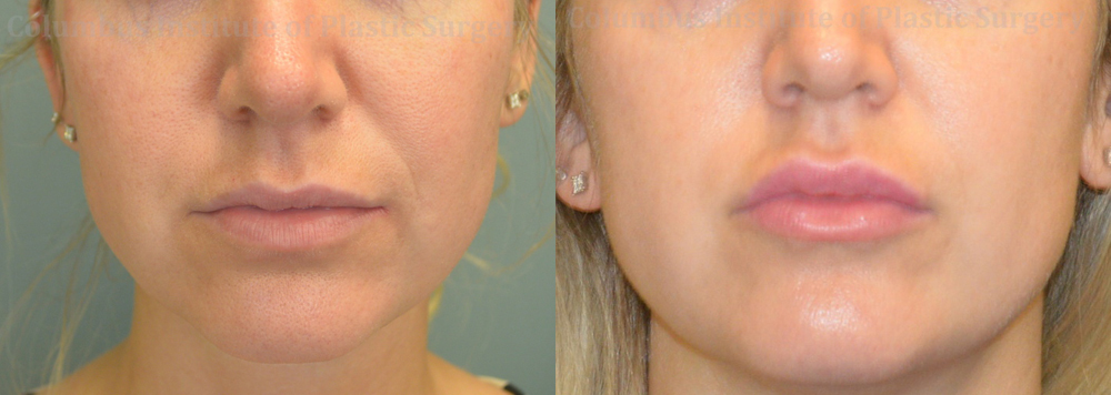 Fillers and Botox before and after photo by Columbus Institute of Plastic Surgery in Columbus, OH