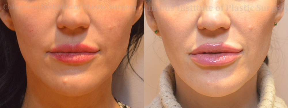 Fillers and Botox before and after photo by Columbus Institute of Plastic Surgery in Columbus, OH
