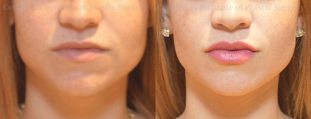 Fillers and Botox before and after photo by Columbus Institute of Plastic Surgery in Columbus, OH