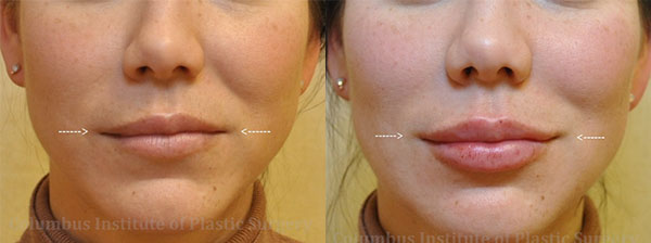 Fillers and Botox before and after photo by Columbus Institute of Plastic Surgery in Columbus, OH