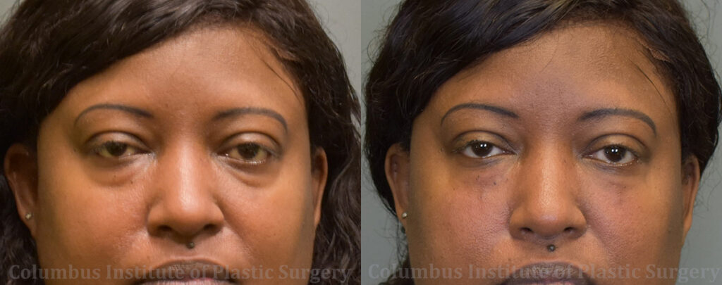Fillers and Botox before and after photo by Columbus Institute of Plastic Surgery in Columbus, OH