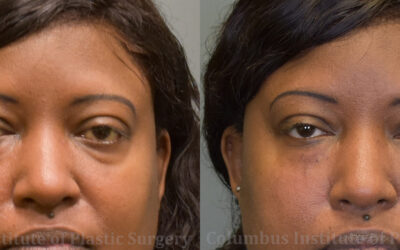 Fillers and Botox before and after photo by Columbus Institute of Plastic Surgery in Columbus, OH Fillers and Botox before and after photo by Columbus Institute of Plastic Surgery in Columbus, OH