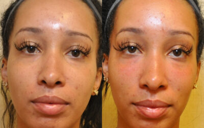 Fillers and Botox before and after photo by Columbus Institute of Plastic Surgery in Columbus, OH Fillers and Botox before and after photo by Columbus Institute of Plastic Surgery in Columbus, OH