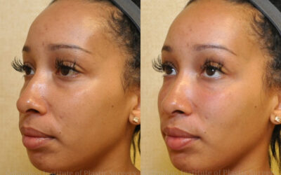 Fillers and Botox before and after photo by Columbus Institute of Plastic Surgery in Columbus, OH Fillers and Botox before and after photo by Columbus Institute of Plastic Surgery in Columbus, OH