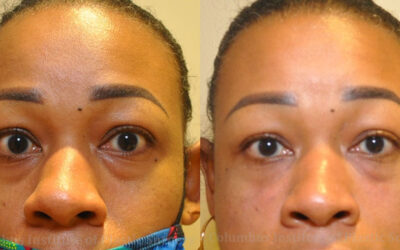 Fillers and Botox before and after photo by Columbus Institute of Plastic Surgery in Columbus, OH Fillers and Botox before and after photo by Columbus Institute of Plastic Surgery in Columbus, OH