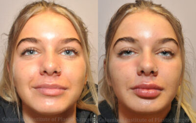 Fillers and Botox before and after photo by Columbus Institute of Plastic Surgery in Columbus, OH Fillers and Botox before and after photo by Columbus Institute of Plastic Surgery in Columbus, OH