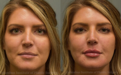 Fillers and Botox before and after photo by Columbus Institute of Plastic Surgery in Columbus, OH Fillers and Botox before and after photo by Columbus Institute of Plastic Surgery in Columbus, OH