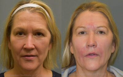 Fillers and Botox before and after photo by Columbus Institute of Plastic Surgery in Columbus, OH Fillers and Botox before and after photo by Columbus Institute of Plastic Surgery in Columbus, OH