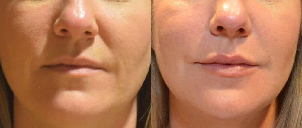 Fillers and Botox before and after photo by Columbus Institute of Plastic Surgery in Columbus, OH