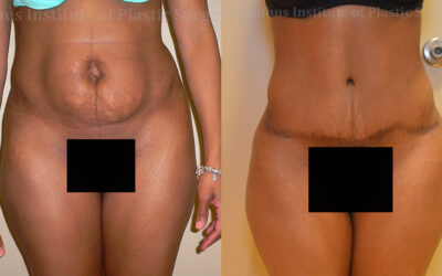 Abdominoplasty (Tummy Tuck) before and after photo by Columbus Institute of Plastic Surgery in Columbus, OH Abdominoplasty (Tummy Tuck) before and after photo by Columbus Institute of Plastic Surgery in Columbus, OH