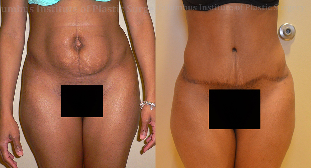 Abdominoplasty (Tummy Tuck) before and after photo by Columbus Institute of Plastic Surgery in Columbus, OH