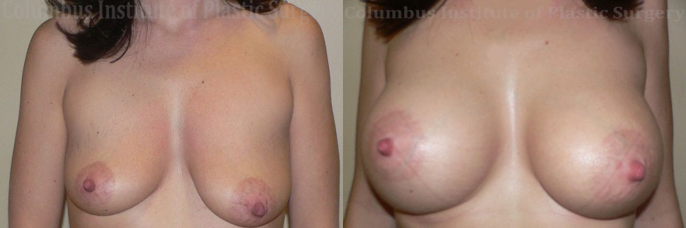 Breast Augmentation before and after photo by Columbus Institute of Plastic Surgery in Columbus, OH