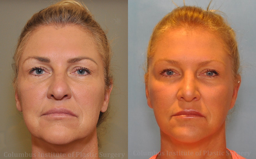 Full Facelift before and after photo by Columbus Institute of Plastic Surgery in Columbus, OH