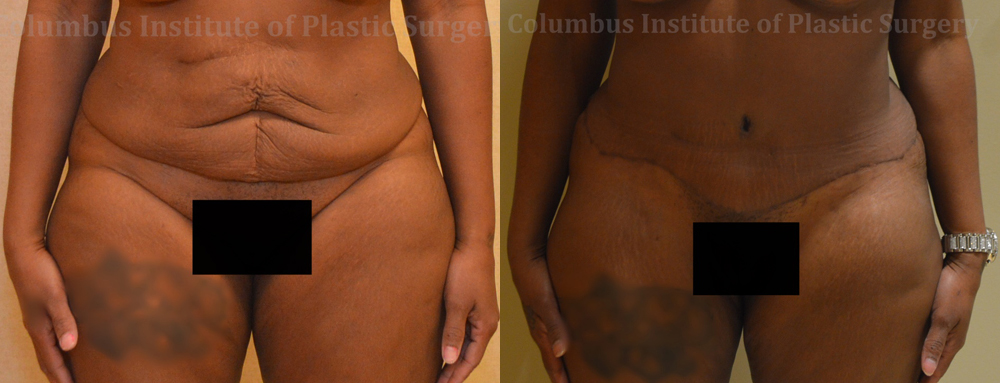 Abdominoplasty (Tummy Tuck) before and after photo by Columbus Institute of Plastic Surgery in Columbus, OH