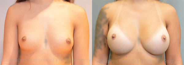 Breast Augmentation – 300cc-400cc before and after photo by Columbus Institute of Plastic Surgery in Columbus, OH