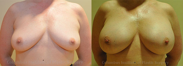 Breast Augmentation before and after photo by Columbus Institute of Plastic Surgery in Columbus, OH