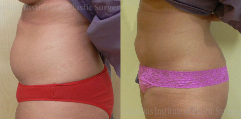 Liposuction before and after photo by Columbus Institute of Plastic Surgery in Columbus, OH