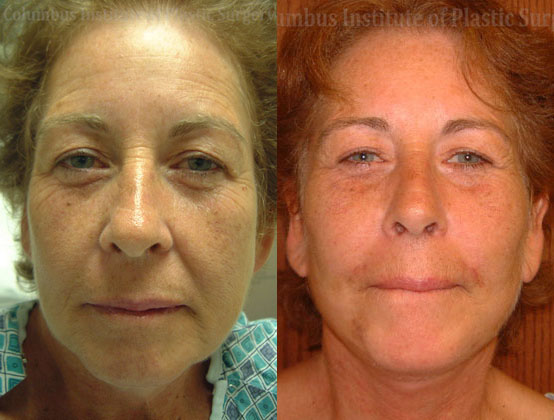 Full Facelift before and after photo by Columbus Institute of Plastic Surgery in Columbus, OH