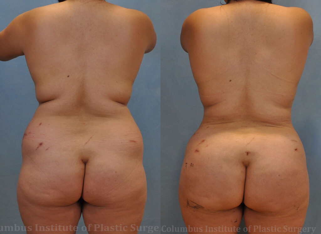 Gluteal (Butt) Augmentation with Fat Grafting (Brazilian Butt Lift) before and after photo by Columbus Institute of Plastic Surgery in Columbus, OH
