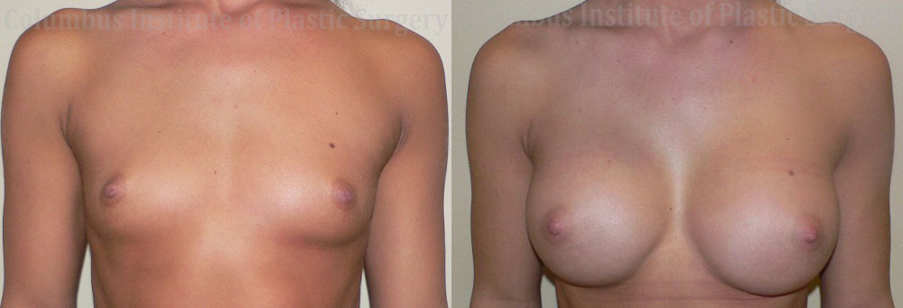 Breast Augmentation before and after photo by Columbus Institute of Plastic Surgery in Columbus, OH