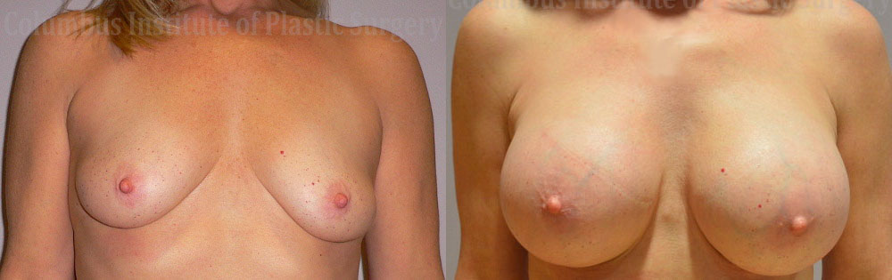 Breast Augmentation – 400cc-500cc before and after photo by Columbus Institute of Plastic Surgery in Columbus, OH