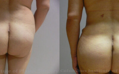 Gluteal (Butt) Augmentation with Fat Grafting (Brazilian Butt Lift) before and after photo by Columbus Institute of Plastic Surgery in Columbus, OH Gluteal (Butt) Augmentation with Fat Grafting (Brazilian Butt Lift) before and after photo by Columbus Institute of Plastic Surgery in Columbus, OH