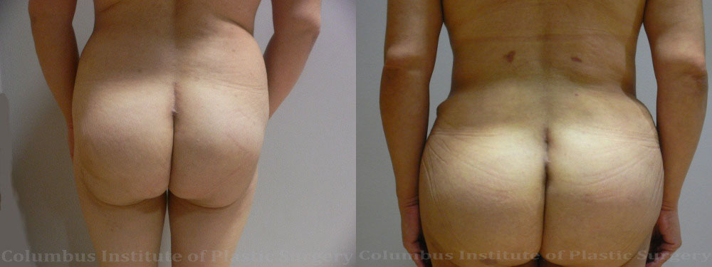 Gluteal (Butt) Augmentation with Fat Grafting (Brazilian Butt Lift) before and after photo by Columbus Institute of Plastic Surgery in Columbus, OH