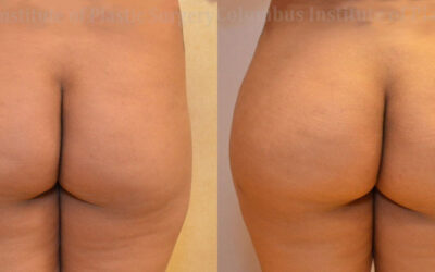 Gluteal (Butt) Augmentation with Fat Grafting (Brazilian Butt Lift) before and after photo by Columbus Institute of Plastic Surgery in Columbus, OH Gluteal (Butt) Augmentation with Fat Grafting (Brazilian Butt Lift) before and after photo by Columbus Institute of Plastic Surgery in Columbus, OH