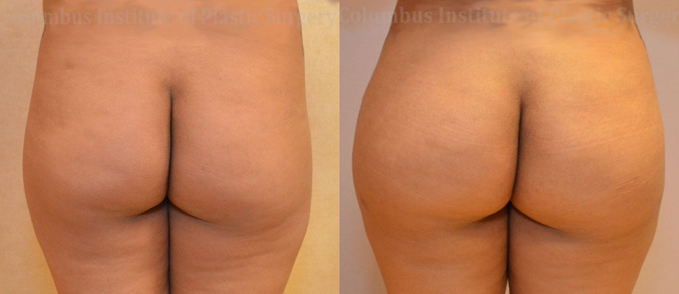 Gluteal (Butt) Augmentation with Fat Grafting (Brazilian Butt Lift) before and after photo by Columbus Institute of Plastic Surgery in Columbus, OH