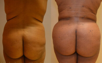 Gluteal (Butt) Augmentation with Fat Grafting (Brazilian Butt Lift) before and after photo by Columbus Institute of Plastic Surgery in Columbus, OH Gluteal (Butt) Augmentation with Fat Grafting (Brazilian Butt Lift) before and after photo by Columbus Institute of Plastic Surgery in Columbus, OH