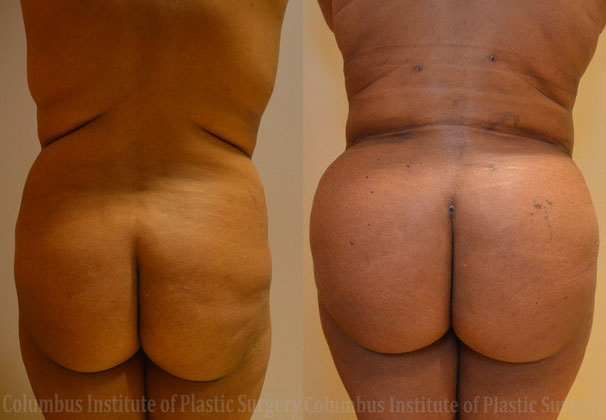 Gluteal (Butt) Augmentation with Fat Grafting (Brazilian Butt Lift) before and after photo by Columbus Institute of Plastic Surgery in Columbus, OH
