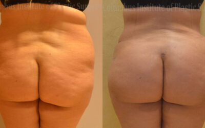 Gluteal (Butt) Augmentation with Fat Grafting (Brazilian Butt Lift) before and after photo by Columbus Institute of Plastic Surgery in Columbus, OH Gluteal (Butt) Augmentation with Fat Grafting (Brazilian Butt Lift) before and after photo by Columbus Institute of Plastic Surgery in Columbus, OH