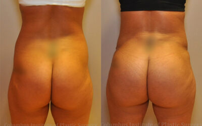 Gluteal (Butt) Augmentation with Fat Grafting (Brazilian Butt Lift) before and after photo by Columbus Institute of Plastic Surgery in Columbus, OH Gluteal (Butt) Augmentation with Fat Grafting (Brazilian Butt Lift) before and after photo by Columbus Institute of Plastic Surgery in Columbus, OH