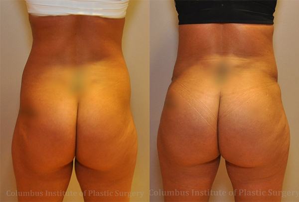 Gluteal (Butt) Augmentation with Fat Grafting (Brazilian Butt Lift) before and after photo by Columbus Institute of Plastic Surgery in Columbus, OH