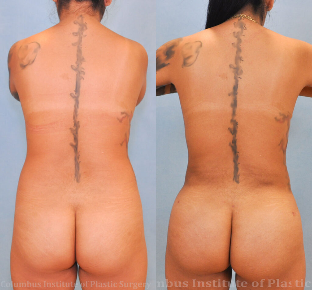 Gluteal (Butt) Augmentation with Fat Grafting (Brazilian Butt Lift) before and after photo by Columbus Institute of Plastic Surgery in Columbus, OH
