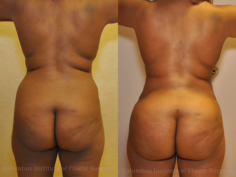 Gluteal (Butt) Augmentation with Fat Grafting (Brazilian Butt Lift) before and after photo by Columbus Institute of Plastic Surgery in Columbus, OH