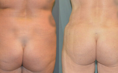 Gluteal (Butt) Augmentation with Fat Grafting (Brazilian Butt Lift) before and after photo by Columbus Institute of Plastic Surgery in Columbus, OH Gluteal (Butt) Augmentation with Fat Grafting (Brazilian Butt Lift) before and after photo by Columbus Institute of Plastic Surgery in Columbus, OH