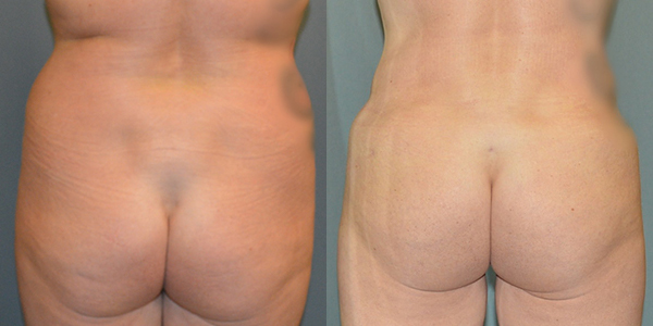 Gluteal (Butt) Augmentation with Fat Grafting (Brazilian Butt Lift) before and after photo by Columbus Institute of Plastic Surgery in Columbus, OH